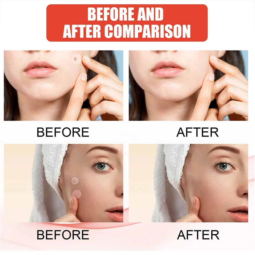 ClearSkin+ Patch - Solution Invisible Anti-Acné